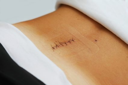 back-surgery-scar