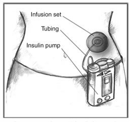 Insulin_Pump