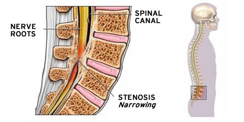 spinal-stenosis