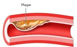 arterial plaque