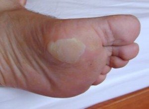 blister