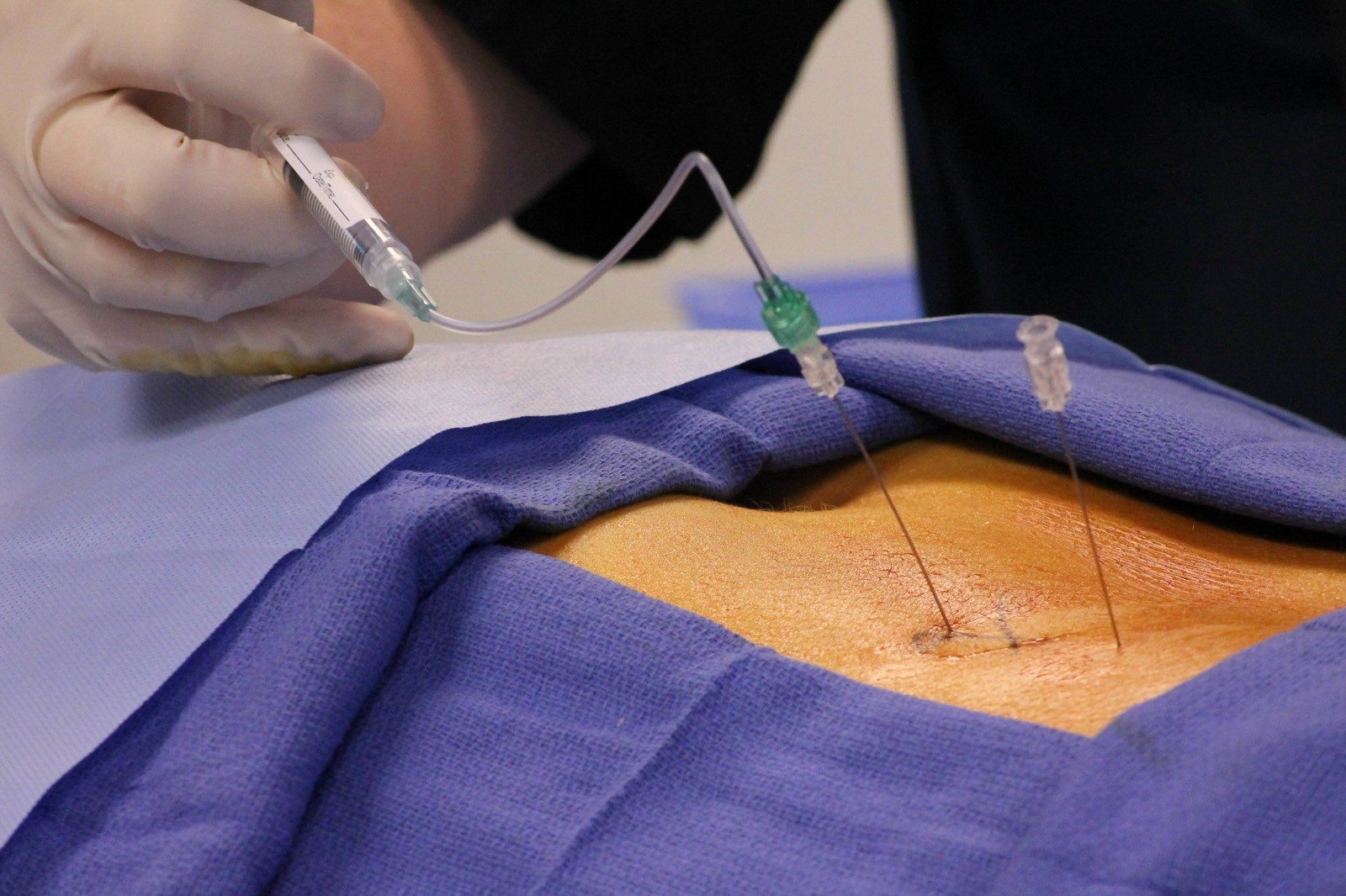 Epidural Spinal Injections Procedure