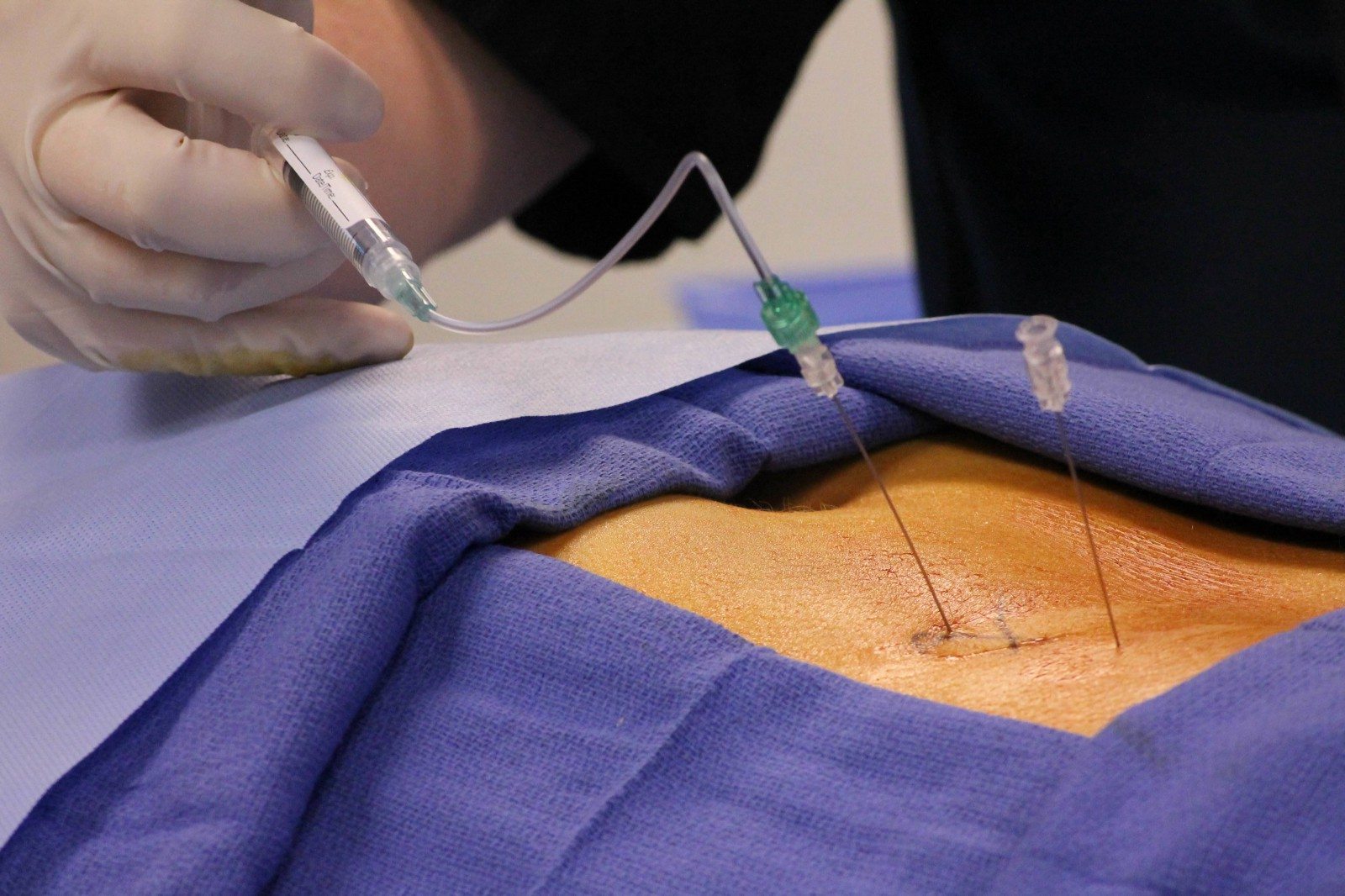 Epidural Injections For Back Pain Are No More Effective Than Placebo