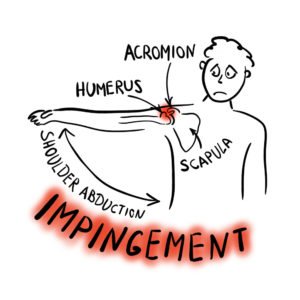 shoulder impingement syndrome