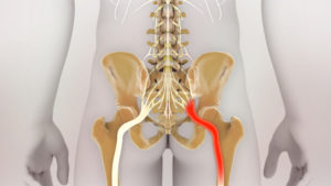 Tingling Sensation in the Buttocks? A Closer Look at Sciatica