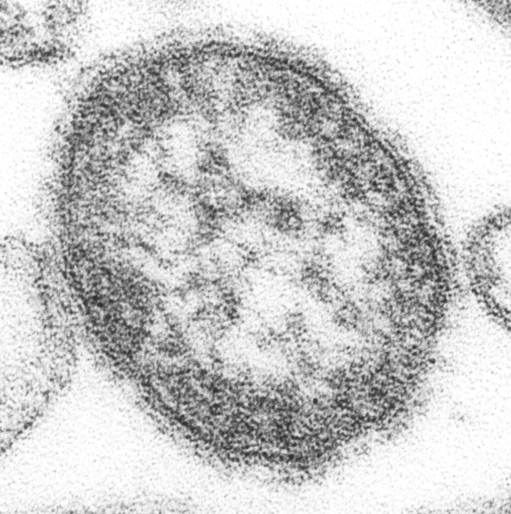 If vaccines are so effective, why is the Measles virus becoming a problem in Texas
